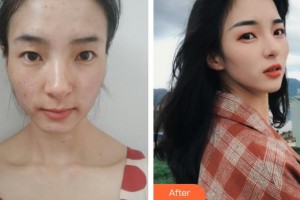 石家莊越然醫(yī)療美容門診部張鴻超整形價(jià)格表附激光祛斑案例展示