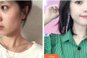 石家莊藍(lán)山醫(yī)療美容醫(yī)院王興奎整形價(jià)格表附激光祛斑案例展示