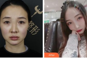 石家莊貴美人醫(yī)療美容醫(yī)院張冠勛整形價(jià)格表附肋軟骨隆鼻案例展示