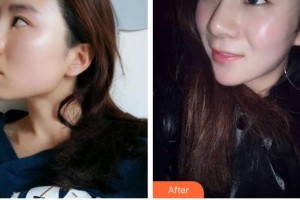 石家莊雅芳亞醫(yī)療美容醫(yī)院馮艷中整形價(jià)格表附鼻部綜合案例展示