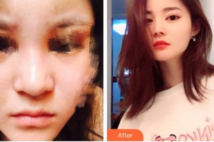 石家莊越然醫(yī)療美容門診部魏寧整形價(jià)格表附肋軟骨隆鼻案例展示