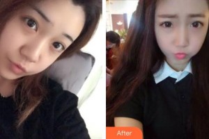 石家莊越然醫(yī)療美容門診部霍慧珍整形價(jià)格表附鼻部綜合案例展示