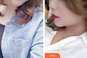 石家莊美萊醫(yī)學(xué)美容醫(yī)院田躍華整形價(jià)格表附激光祛斑案例展示