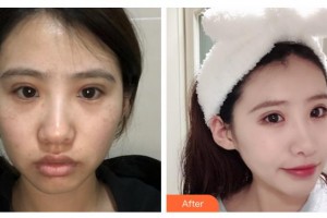 石家莊俏之翼醫(yī)療美容門診部吳志宏整形價(jià)格表附激光祛斑案例展示