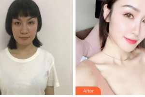 石家莊俏之翼醫(yī)療美容門診部林東勛整形價(jià)格表附鼻部綜合案例展示