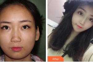 石家莊俏之翼醫(yī)療美容門診部金炫廷整形價(jià)格表附鼻部綜合案例展示