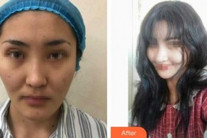 石家莊美萊醫(yī)學(xué)美容醫(yī)院張芳整形價(jià)格表附鼻部綜合案例展示