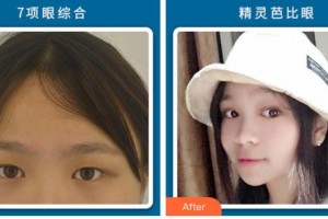 石家莊艾麥德醫(yī)療美容門診部王秀紅整形價格表附切開雙眼皮案例展示