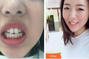 石家莊艾麥德醫(yī)療美容門診部張曉建整形價格表附隱形托槽矯正案例展示