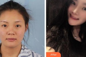 黑龍江中醫(yī)藥大學附屬第一醫(yī)院眼科姚靖整形價格表附鼻部綜合案例展示