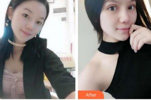 黑龍江中醫(yī)藥大學附屬第一醫(yī)院眼科孫河整形價格表附眼部綜合】案例展示