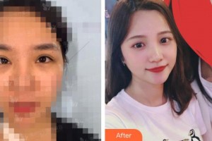 黑龍江中醫(yī)藥大學附屬第一醫(yī)院眼科樊曉瑞整形價格表附眼部綜合案例展示