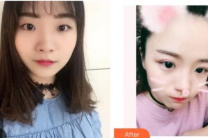 黑龍江中醫(yī)藥大學附屬第一醫(yī)院眼科張莉整形價格表附定點雙眼皮案例展示