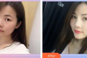 黑龍江中醫(yī)藥大學附屬第一醫(yī)院眼科劉靜霞整形價格表附切開雙眼皮案例展示