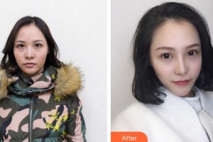 石家莊愛(ài)瑞爾醫(yī)療美容診所陳月整形價(jià)格表附眼部綜合案例展示