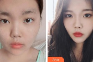 石家莊倩仕醫(yī)療整形美容門診部李娟整形價(jià)格表附光子嫩膚案例展示