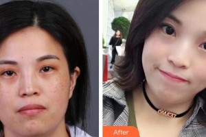 石家莊匯美天成醫(yī)療美容門診部王麗整形價(jià)格表附激光祛斑案例展示