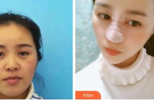 石家莊匯美天成醫(yī)療美容門診部翟彥剛整形價(jià)格表附鼻部綜合案例展示