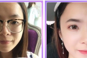 石家莊康體醫(yī)療美容門診部孫衛(wèi)海整形價(jià)格表附埋線雙眼皮案例展示