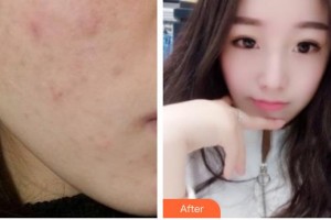 唐山美尚醫(yī)療美容診所張永新整形價(jià)格表附去痘印痘坑案例展示