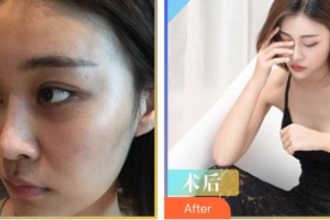 唐山金鳳凰美容整形醫(yī)院劉華濟整形價格表附自體脂肪隆胸案例展示