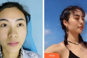 唐山美泉醫(yī)療美容診所吉云麗整形價格表附耳軟骨復合隆鼻案例展示