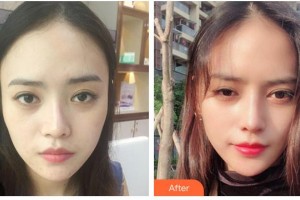 唐山煤醫(yī)整形美容醫(yī)院郭萬厚整形價格表附眼部綜合案例展示