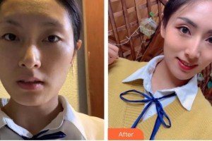 唐山美聯(lián)臣醫(yī)療美容醫(yī)院文丁一整形價格表附埋線提升案例展示