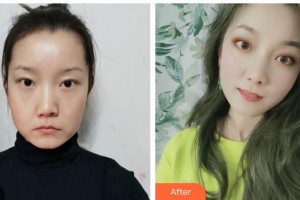 唐山煤醫(yī)整形美容醫(yī)院程守先整形價(jià)格表附埋線提升案例展示