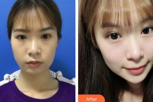 唐山煤醫(yī)整形美容醫(yī)院李承鍾整形價(jià)格表附埋線提升案例展示