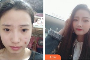 唐山煤醫(yī)整形美容醫(yī)院陶智潞整形價(jià)格表附去痘印痘坑案例展示