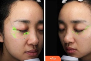 唐山星范醫(yī)療美容門診部劉俊偉整形價(jià)格表附埋線提升案例展示