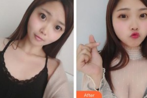 唐山灤縣人民醫(yī)院美容整形科吳永柏整形價(jià)格表附假體隆胸案例展示