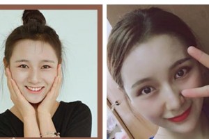 唐山美尚醫(yī)療美容診所趙晟弼整形價格表附眼部綜合案例展示