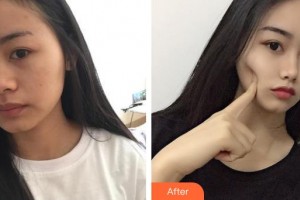 唐山惠美登醫(yī)療美容醫(yī)院彭艷整形價(jià)格表附光子嫩膚案例展示