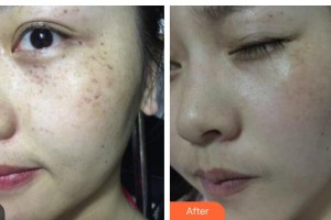 唐山京順整形美容醫(yī)院程春玉整形價(jià)格表附祛斑祛痣案例展示