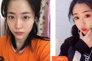 唐山聯(lián)合麗珍醫(yī)療美容門(mén)診部樸惠恩整形價(jià)格表附超聲提拉案例展示