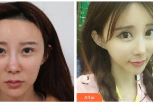 唐山聯(lián)合麗珍醫(yī)療美容門(mén)診部金泰憲整形價(jià)格表附埋線提升案例展示