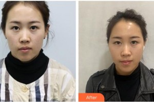 唐山星范醫(yī)療美容門(mén)診部高圣明整形價(jià)格表附埋線提升案例展示