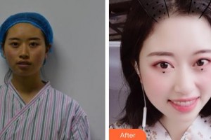 唐山星范醫(yī)療美容門(mén)診部劉勇整形價(jià)格表附埋線提升案例展示