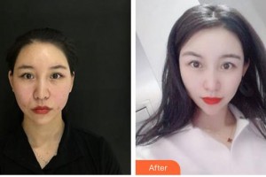 唐山星范醫(yī)療美容門(mén)診部王海艷整形價(jià)格表附埋線提升案例展示