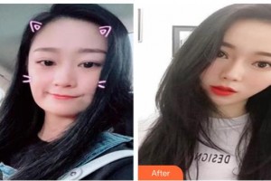 唐山煤醫(yī)整形美容醫(yī)院陳俊蕊整形價(jià)格表附埋線提升案例展示