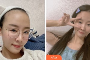 武漢思美妍醫(yī)療美容門診部李貴海整形價(jià)格表附植發(fā)案例展示