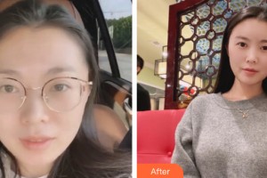 武漢仁愛時(shí)光醫(yī)院整形美容中心張紹斌整形價(jià)格表附自體脂肪填充案例展示