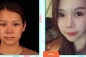唐山光明醫(yī)院李淑香整形價(jià)格表附切開(kāi)雙眼皮案例展示