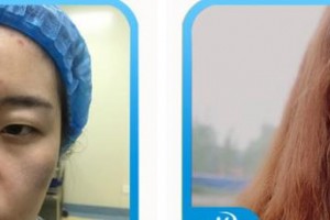 唐山光明醫(yī)院高澤明整形價(jià)格表附開(kāi)內(nèi)眼角案例展示