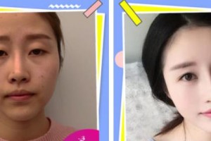 唐山光明醫(yī)院宋東軍整形價(jià)格表附切開(kāi)雙眼皮案例展示