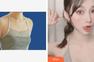 武漢伊萊美醫(yī)療美容門診部余國勝整形價(jià)格表附自體脂肪豐胸案例展示