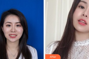 武漢愛齒爾口腔門診部盧丹整形價(jià)格表附牙齒矯正案例展示