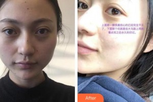 秦皇島紀輝整形美容醫(yī)院紀輝整形價格表附激光點痣案例展示